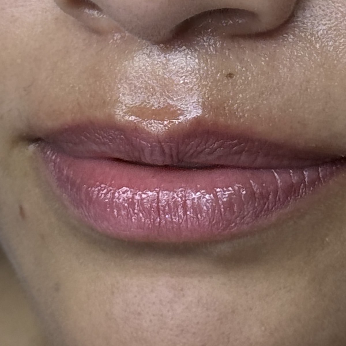 Antes — Preenchimento labial — resultado real da cliente