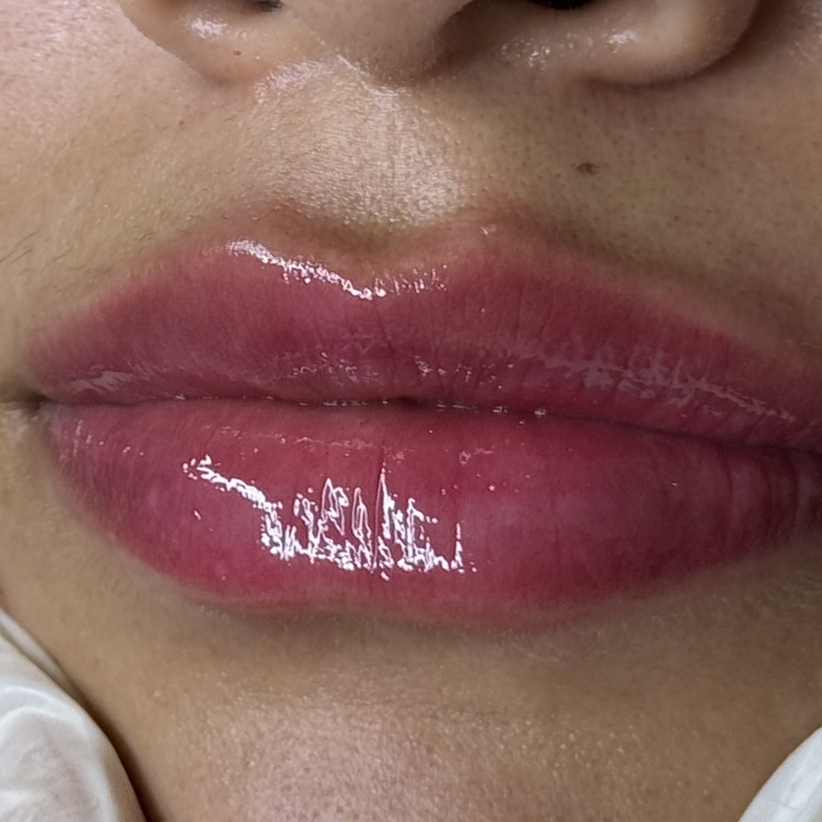 Depois — Preenchimento labial — resultado real da cliente