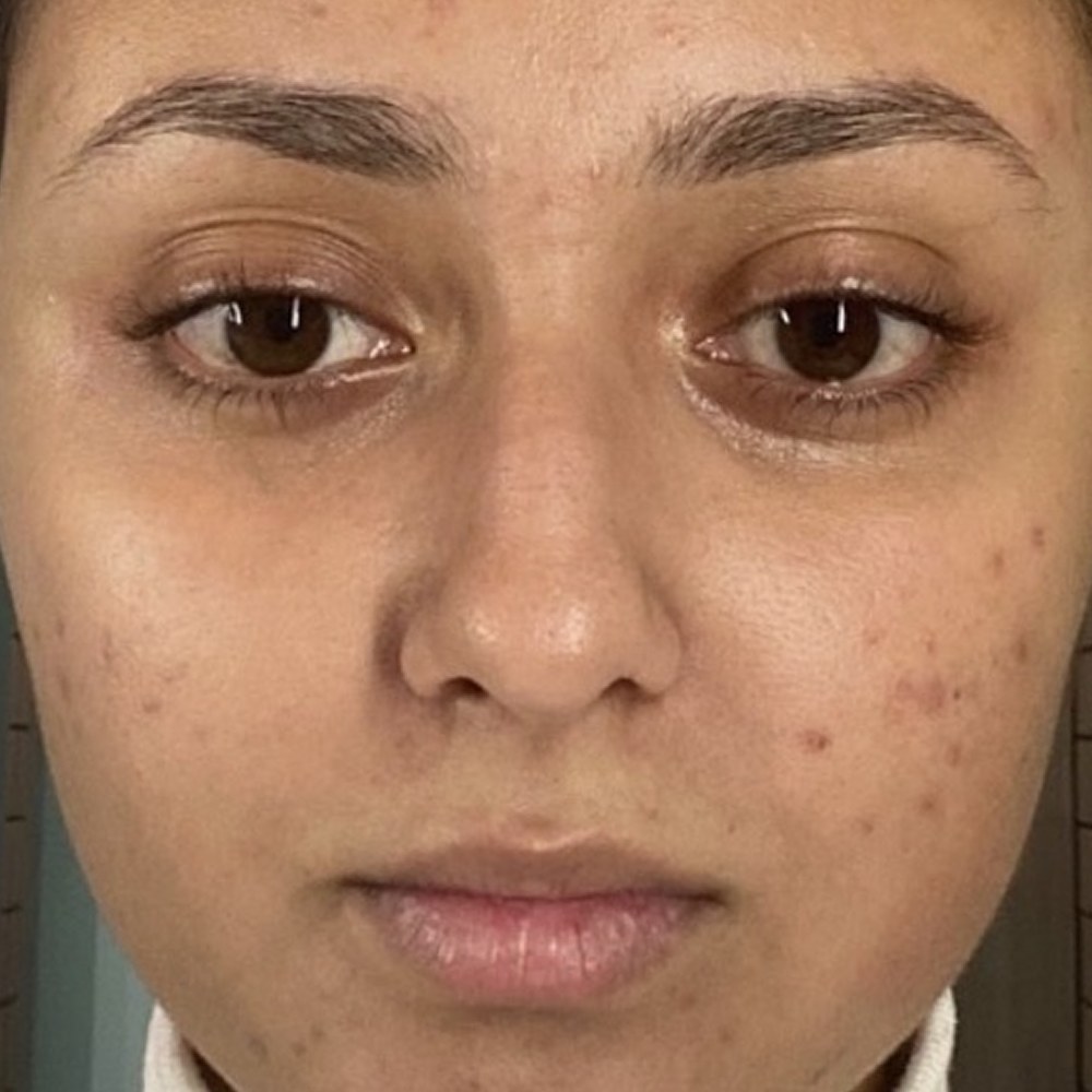 Antes — Peeling do Mar Morto — resultado real da cliente