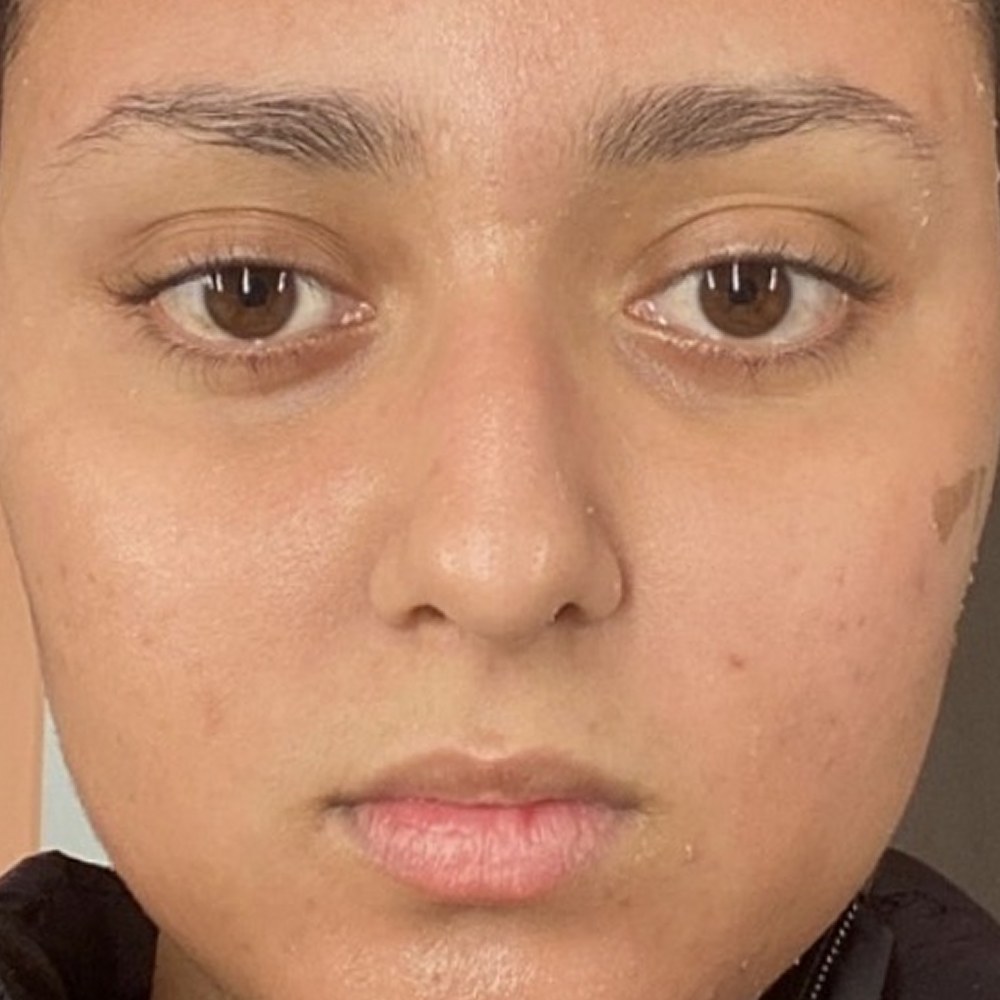 Depois — Peeling do Mar Morto — resultado real da cliente